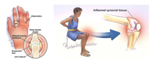 Reactive-arthritis-ReA.png Reactive-arthritis-ReA.png